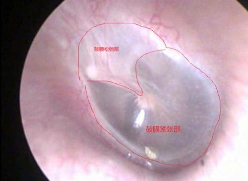 成都治療鼓膜穿孔預(yù)約仁品？