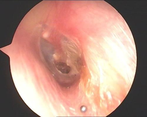 鼓膜穿孔較大怎么治療？