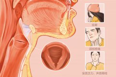 孩子得了聲帶小結(jié)如何治療好？成都仁品耳鼻喉醫(yī)院分析