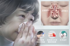 鼻甲肥大危害有什么？成都耳鼻喉醫(yī)院解答