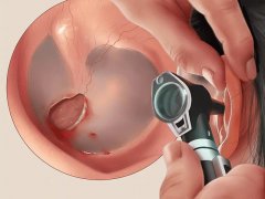 成都鼓膜穿孔都需要做哪些檢查？