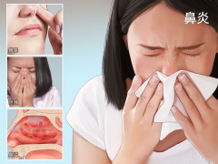 成都鼻炎會引起哪些癥狀？如何減少鼻炎發(fā)作？