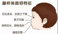 孩子腺樣體肥大有哪些征兆？成都耳鼻喉科醫(yī)生解答